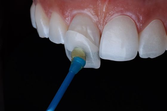 Permanente composiet Emax Zirconia Laminate Finers Tandheelkundige natuurlijke look