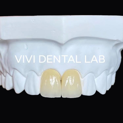 Gehele kaak Tandheelkundige Zirconia brug Implantat Kroon Translucentie Esthetisch
