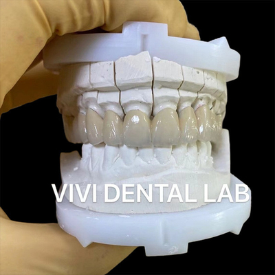 Precieze tandheelkundige lab kronen Esthetisch porselein Zirconia tandkronen