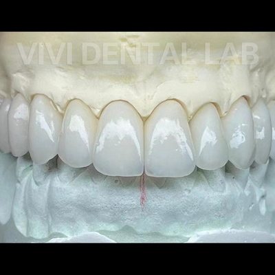 Tandheelkundig laboratorium Zirconia kronen en bruggen Werken Professionele stabiel
