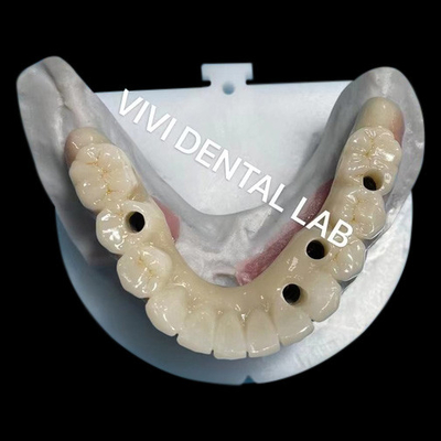 Meerlaagse Zirconia schroef vastgehouden brug Biocompatibel op metalen structuur