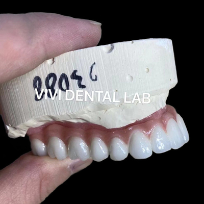 Natuurlijk uitziende esthetische schroef gereserveerd zirconia implantaat kroon Langdurig