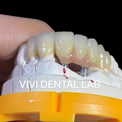 Porselein Zirconia Tandheelkundige Implantatie Brug Professionele Hoge Esthetiek