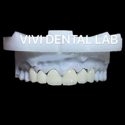 Dental Anterior Zirconia Bridge ISO-gecertificeerde snelle omlooptijd