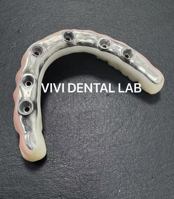Esthetische volledige Zirconia brug met Titanium Bar gescreefd behouden uit China tandheelkundig lab