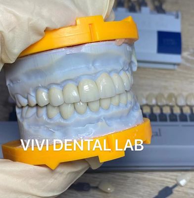 Het hoge van Esthetische van de Vernisjesincisal Tandenemax Gelamineerde van de Doorschijnendheidschina Tandlaboratorium