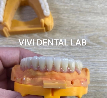 Gehele kaak Tandheelkundige Zirconia brug Implantat Kroon Translucentie Esthetisch