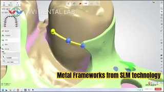 Metal Partial Framework van SLM-technologie