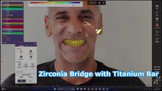 Zirconia Bridge Titanium Bar Alles op X-oplossing